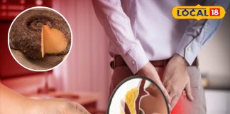 Hemorrhoids Treatment get permanent relief know ayurvedic tips by expert, इस बीमारी को बताने में अगर शरमा रहे, तो आपकी सबसे बड़ी भूल, आयुर्वेद के इस इलाज से होगा खात्मा!