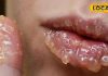 सिर्फ ठंड नहीं… ये छुपी कमी फाड़ रही है आपके होंठ!..यहां जानिए सही उपचार – Uttarakhand News