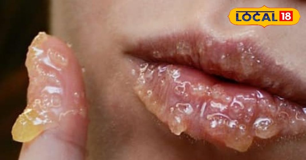 सिर्फ ठंड नहीं… ये छुपी कमी फाड़ रही है आपके होंठ!..यहां जानिए सही उपचार – Uttarakhand News