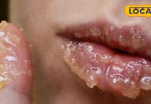 सिर्फ ठंड नहीं… ये छुपी कमी फाड़ रही है आपके होंठ!..यहां जानिए सही उपचार – Uttarakhand News