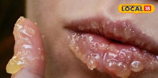 सिर्फ ठंड नहीं… ये छुपी कमी फाड़ रही है आपके होंठ!..यहां जानिए सही उपचार – Uttarakhand News