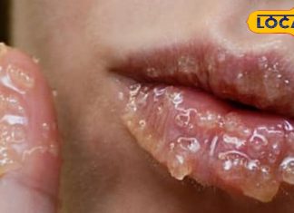 सिर्फ ठंड नहीं… ये छुपी कमी फाड़ रही है आपके होंठ!..यहां जानिए सही उपचार – Uttarakhand News