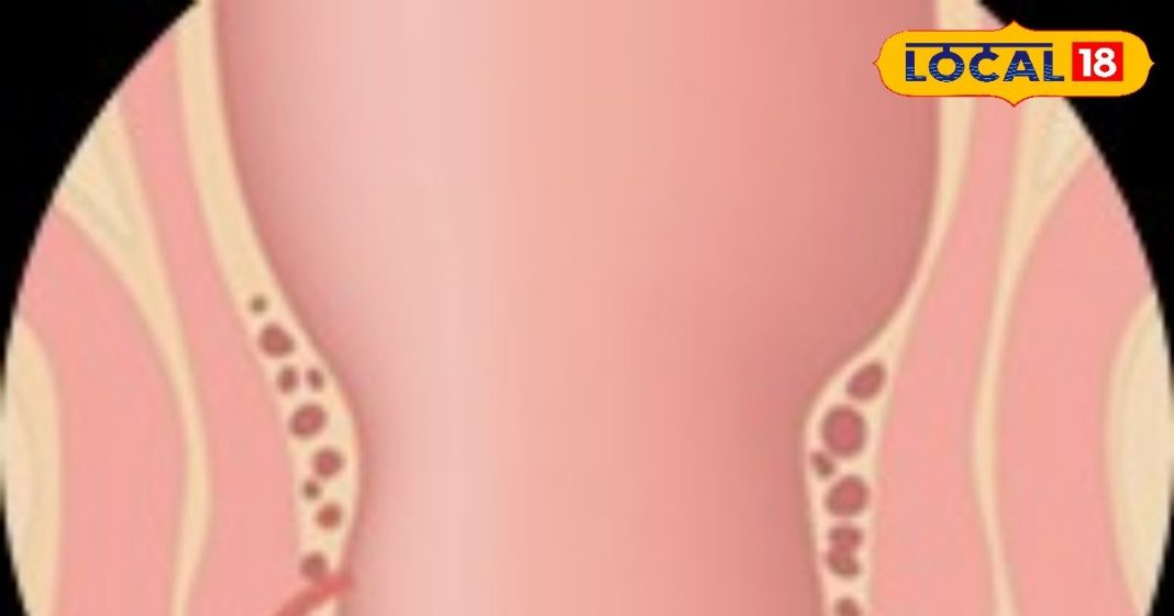 बिना ऑपरेशन भी ठीक हो सकता है फिस्टुला, ऋषिकेश में अपनाया जा रहा खास तरीका, मरीजों को मिल रही राहत – Uttarakhand News