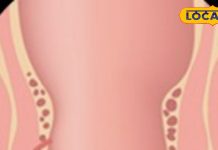 बिना ऑपरेशन भी ठीक हो सकता है फिस्टुला, ऋषिकेश में अपनाया जा रहा खास तरीका, मरीजों को मिल रही राहत – Uttarakhand News