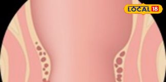 बिना ऑपरेशन भी ठीक हो सकता है फिस्टुला, ऋषिकेश में अपनाया जा रहा खास तरीका, मरीजों को मिल रही राहत – Uttarakhand News