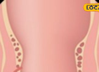 बिना ऑपरेशन भी ठीक हो सकता है फिस्टुला, ऋषिकेश में अपनाया जा रहा खास तरीका, मरीजों को मिल रही राहत – Uttarakhand News