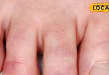 सर्दियों में उंगलियों की सूजन और दर्द से हैं परेशान? अपनाएं ये आसान घरेलू उपाय; जल्द मिलेगा आराम