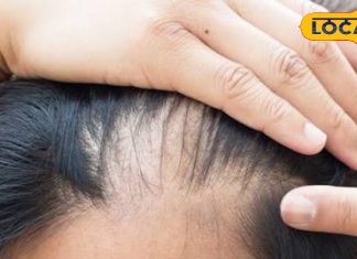 hair-care-winter-remain-moisturized-will-not-break-How-to-use-yogurt, सर्दियों में झड़ते बालों पर ब्रेक लगाएगा ये घरेलू इलाज, सिर पर हमेशा बनी रहेगा नमी! डैंड्रफ से आजादी