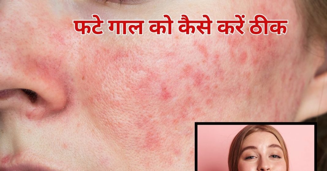 इस सर्द मौसम में क्या आपके भी गाल फट रहे हैं? 5 चीजों के इस्तेमाल से हल हो जाएगी समस्या