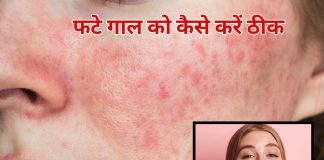 इस सर्द मौसम में क्या आपके भी गाल फट रहे हैं? 5 चीजों के इस्तेमाल से हल हो जाएगी समस्या