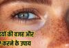 How to reduce facial Freckles: किन विटामिंस की कमी से चेहरे पर होती हैं झाइयां? कैसे करें दूर