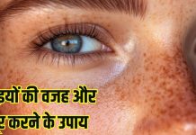 How to reduce facial Freckles: किन विटामिंस की कमी से चेहरे पर होती हैं झाइयां? कैसे करें दूर