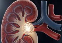 किडनी में पथरी होने पर कौन सी दाल खानी चाहिए?