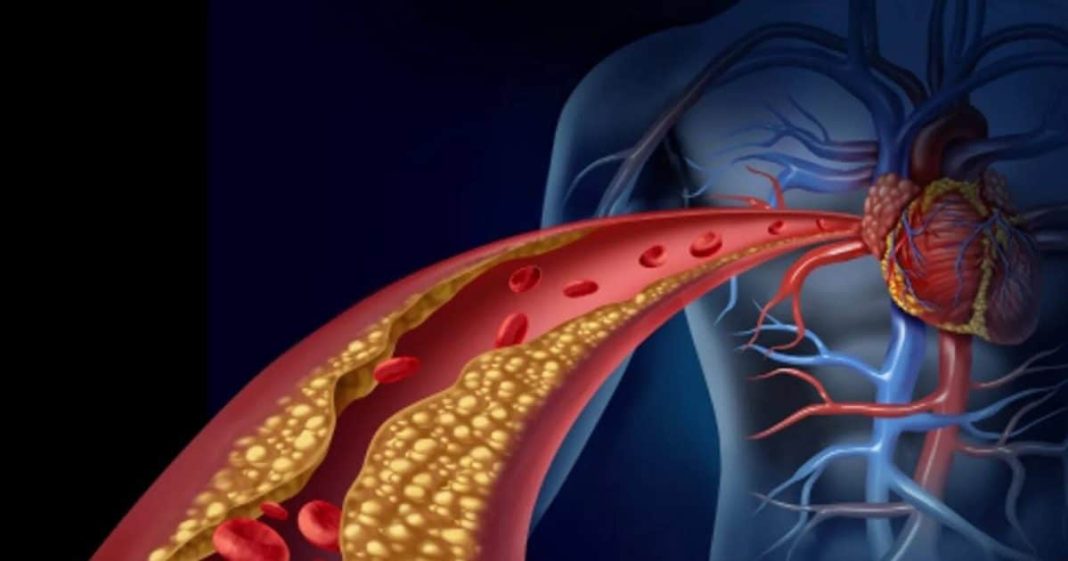 Lower Your Cholesterol: गंदे कोलेस्ट्रॉल को बिना दवा-इलाज कैसे कम करें?