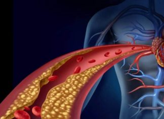 Lower Your Cholesterol: गंदे कोलेस्ट्रॉल को बिना दवा-इलाज कैसे कम करें?