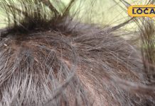 Beauty Tips : नारियल-नींबू का ये देसी जुगाड़! गायब कर देगा बालों से डैंड्रफ, बस ऐसे करें इस्तेमाल – Uttar Pradesh News