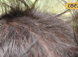 Beauty Tips : नारियल-नींबू का ये देसी जुगाड़! गायब कर देगा बालों से डैंड्रफ, बस ऐसे करें इस्तेमाल – Uttar Pradesh News