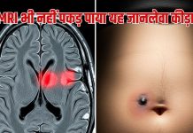 29 साल के व्यक्ति का दिमाग खाने लगा कीड़ा, MRI भी नहीं पकड़ पाया, डॉक्टर ने पेट पर निशान देख बचाई जान