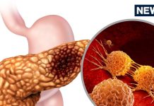 Pancreatic Cancer Treatment: सबसे जानलेवा कैंसर का इलाज मिल गया?