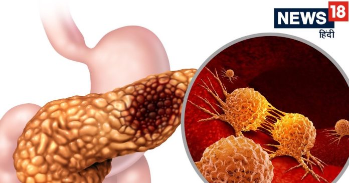 Pancreatic-Cancer-2026-01-9b5eccaacbf690d826d4c2c61dc8055c-16x9.jpg