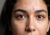 Why do large pimples and acne appear on face: चेहरे पर पिंपल्स- मुंहासे क्यों होते है?