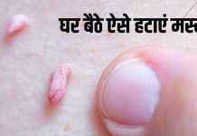 Remove Warts Naturally Without Surgery 5 Effective Home Remedies | बिना ऑपरेशन मस्से कैसे हटाएं | अनचाहे मस्से हटाने के 5 घरेलू उपाय