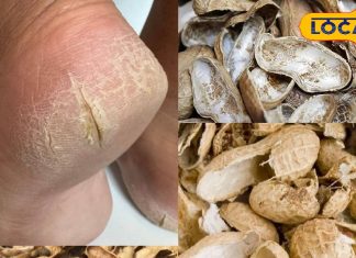 Beauty Tips : सर्दी में फटती एड़ियों ने कर रखा परेशान? मूंगफली के छिलके से बनाएं धांसू क्रीम, जानें तरीका