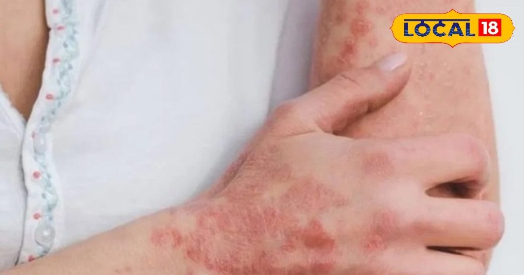 शरीर पर लाल चकत्ते, खुजली का संकेत नहीं, इसे नजरअंदाज करना पड़ सकता है भारी, ऐसे करें इससे बचाव