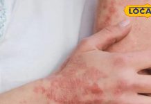 शरीर पर लाल चकत्ते, खुजली का संकेत नहीं, इसे नजरअंदाज करना पड़ सकता है भारी, ऐसे करें इससे बचाव