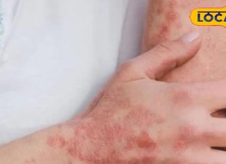 शरीर पर लाल चकत्ते, खुजली का संकेत नहीं, इसे नजरअंदाज करना पड़ सकता है भारी, ऐसे करें इससे बचाव
