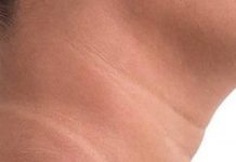 गर्दन का कालापन किन बीमारियों का संकेत? घरेलू उपचार से भी न हो ठीक तो जरूर चेक करवाएं ये चीज