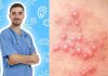 शरीर के इन हिस्सों पर निकल आते हैं छोटे-छोटे दाने, हर्पीज वायरस का हो गए शिकार, क्या है इसका इलाज?